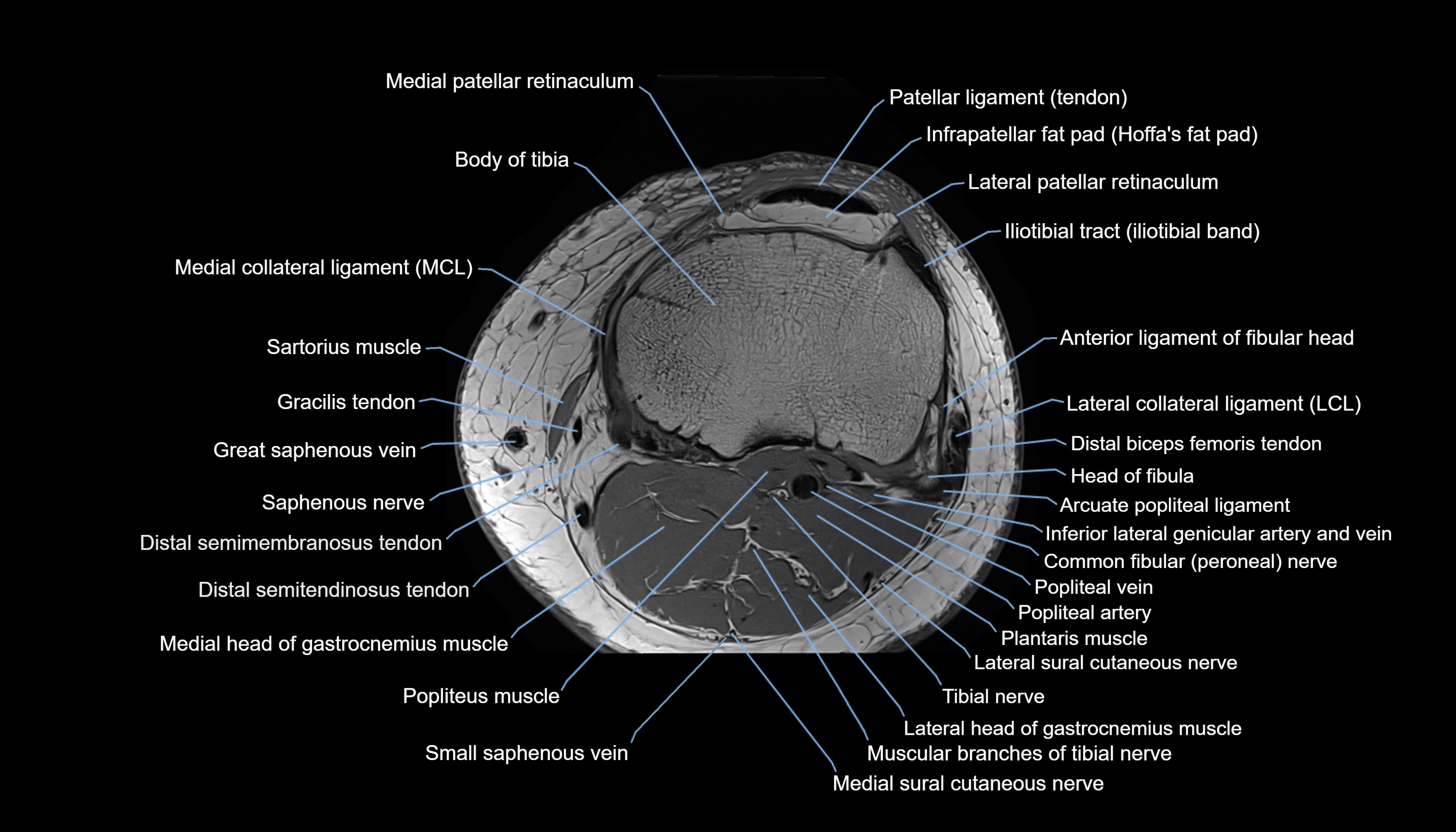 MRI knee  axial cross sectional anatomy 3T radiology  image-img-00001-00036.webp